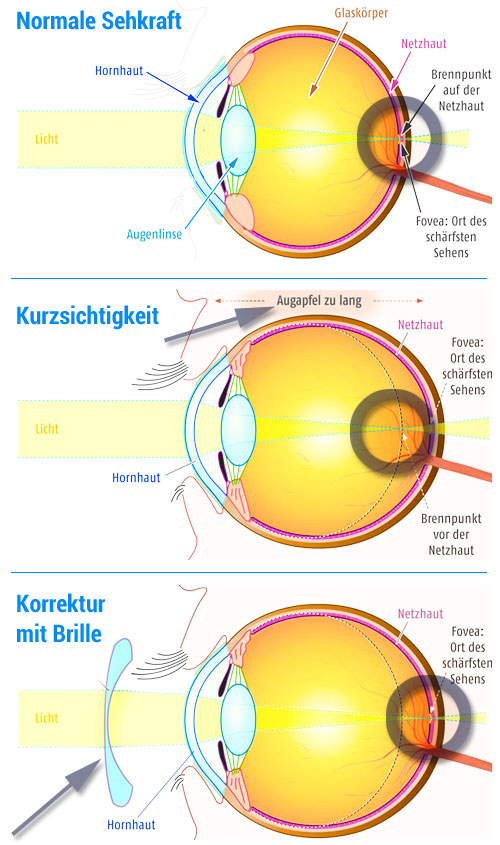 Menschliches Auge:  Normales Sehen, Kurzsichtigkeit, Korrektur