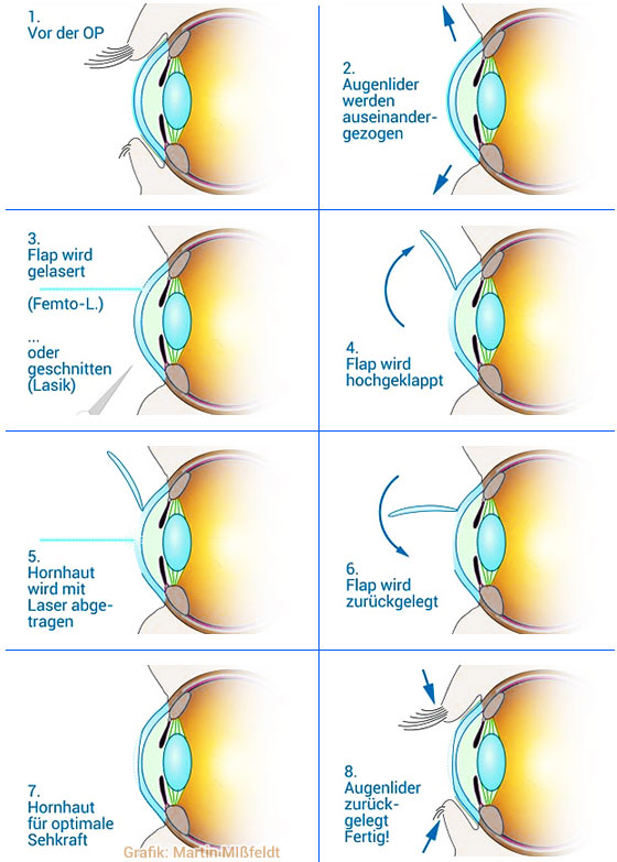 Augenlaserbehandlung (Operation Laserverfahren)